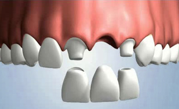 Axis Dental bridge service
