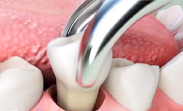 Axis Dental Tooth Extractions service