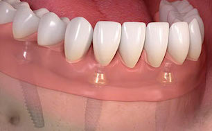 Axis Dental Implant Therapy service