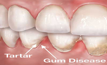 Axis Dental Periodontal (Gum) Disease service