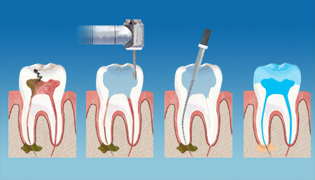 Axis Dental Endodontics Therapy service